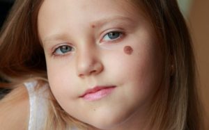 Blog 25 birth marks and reincarnation